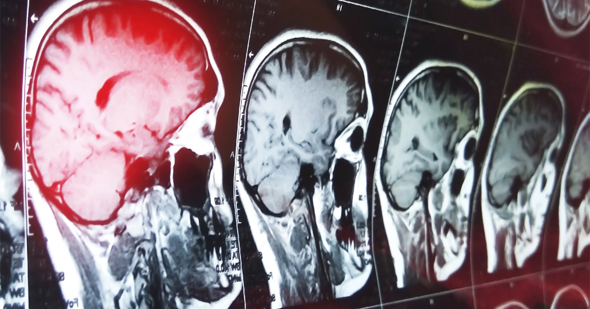 Can Traumatic Brain Injuries Occur from Car Accidents?
