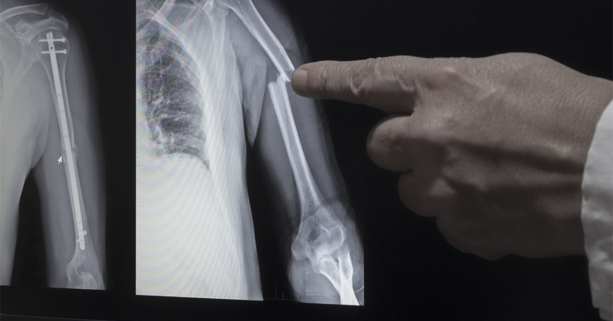What Types of Bone Fractures Are Caused by Car Accidents?